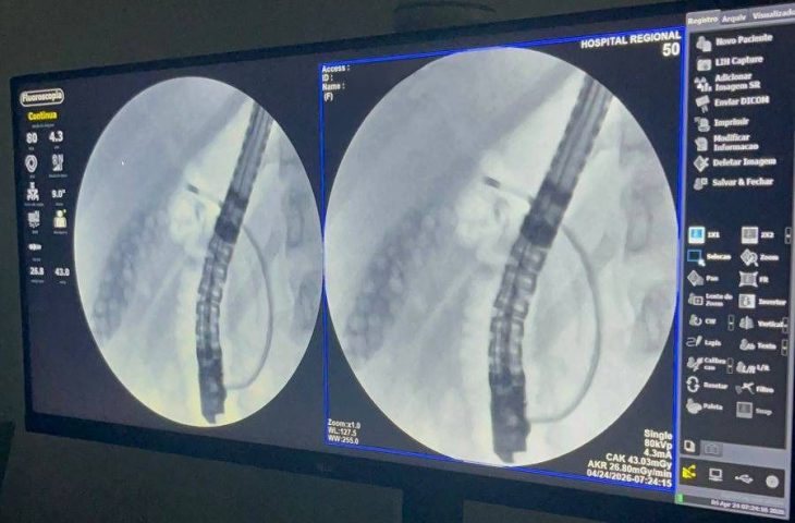 Exame inédito marca avanço da alta complexidade no Hospital Regional de Dourados